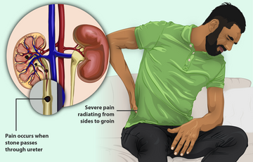 Natural Ayurvedic remedies for kidney stones – Herbs, diet, and lifestyle changes for kidney stone relief.