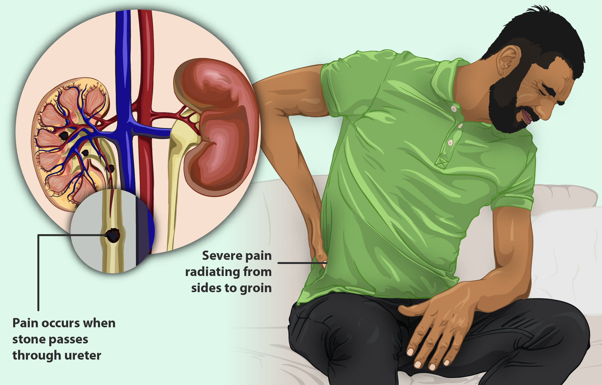 kidney stone best ayurvedic treatment