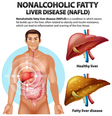 Non alcoholic fatty liver disease 