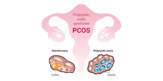 PCOS